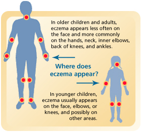 Common places for eczema to occur.